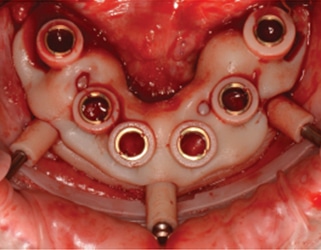 Complete & Immediate Dentures